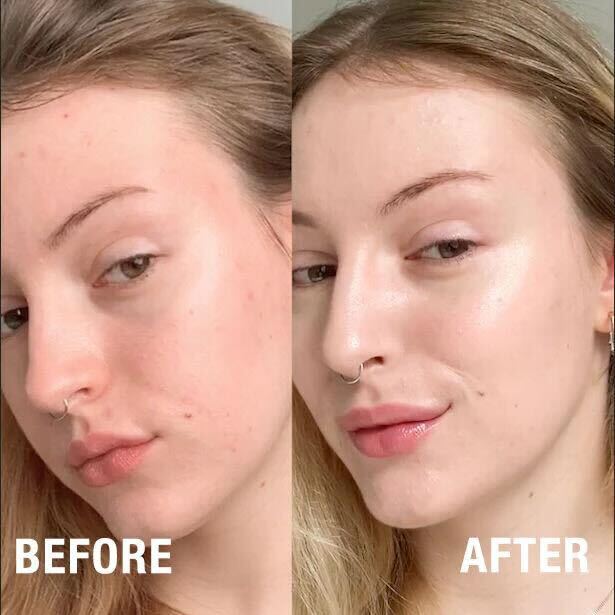 THE POTIONS ニキビを防ぐ!お肌改善セット